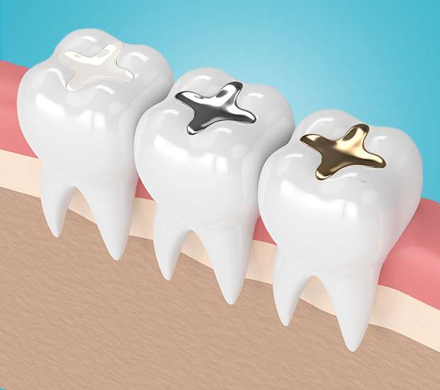 Stamford Composite Fillings