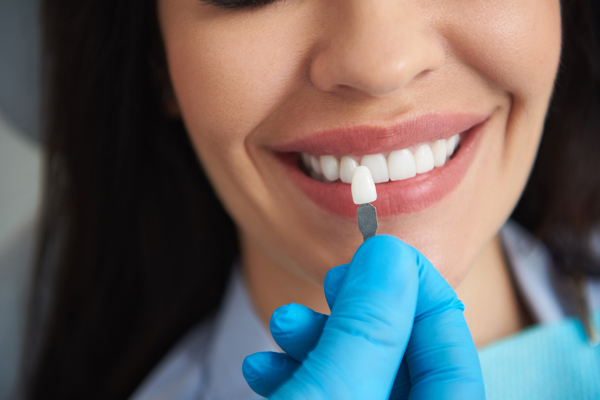 The Step By Step Process Of Getting Dental Veneers